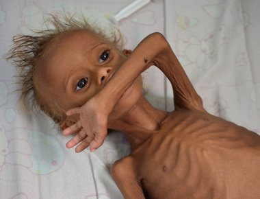 Πολύ σκληρές εικόνες - Παιδιά που γεννήθηκαν παραμορφωμένα από τον πόλεμο στην Υεμένη (βίντεο)